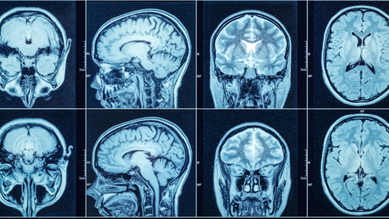 brain scan showing multiple sides 