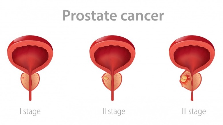 stages of prostate cancer