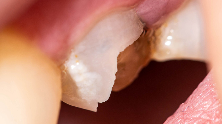 A damaged tooth