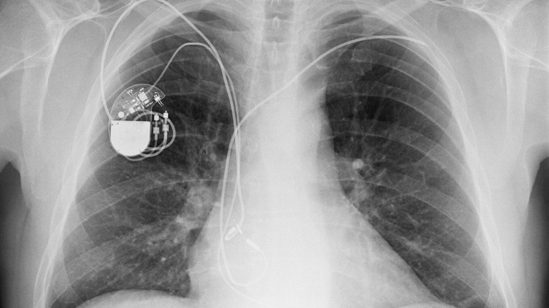 x-ray of a pacemaker in chest cavity