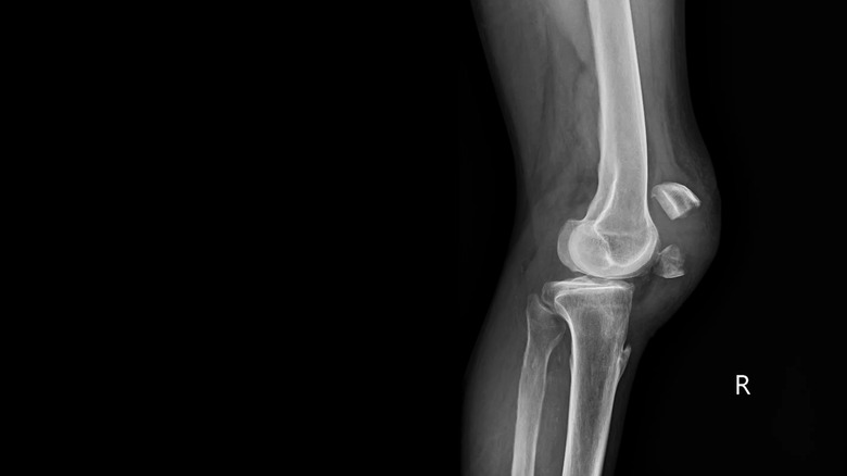 X-Ray of a broken knee