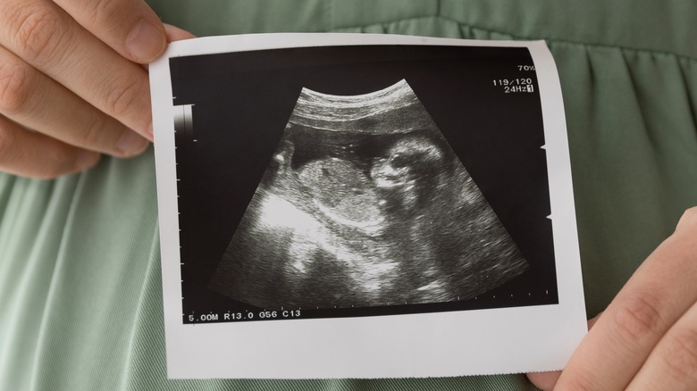 Woman holding a picture of a prenatal ultrasound