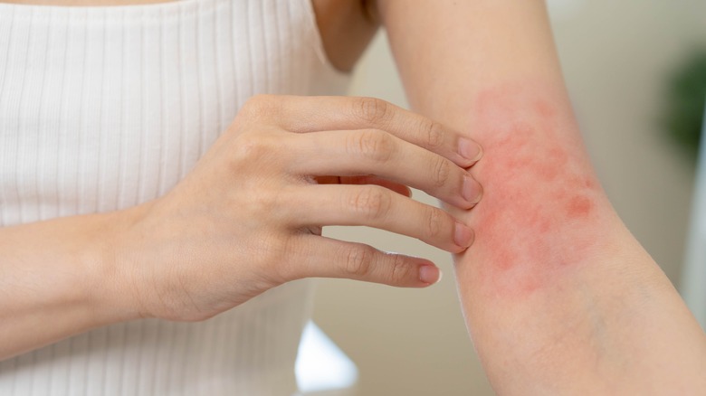 woman with a skin rash