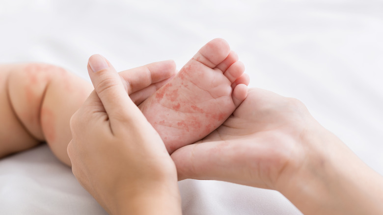 A baby afflicted with measles