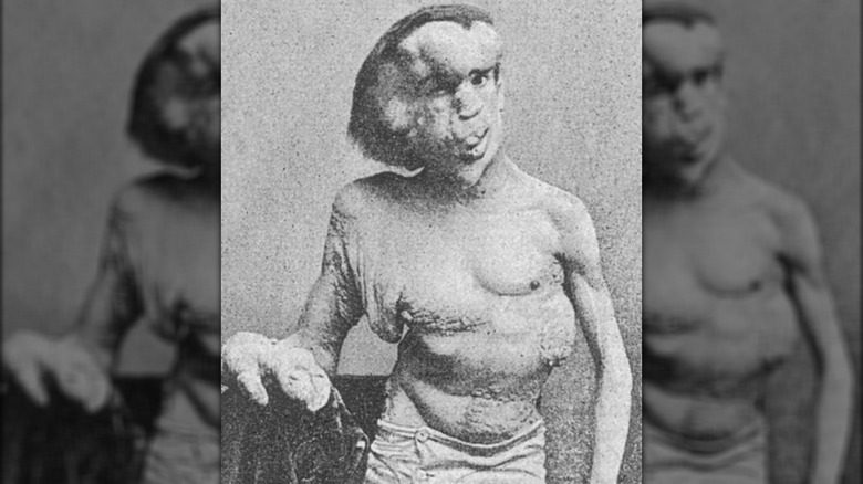 Joseph Merrick without a shirt