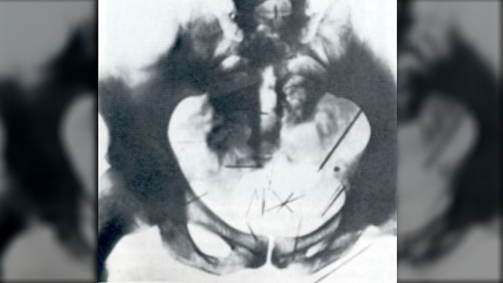 An x-ray of Albert Fish's pelvis