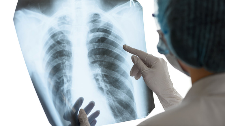 doctor looking at tuberculosis x-ray
