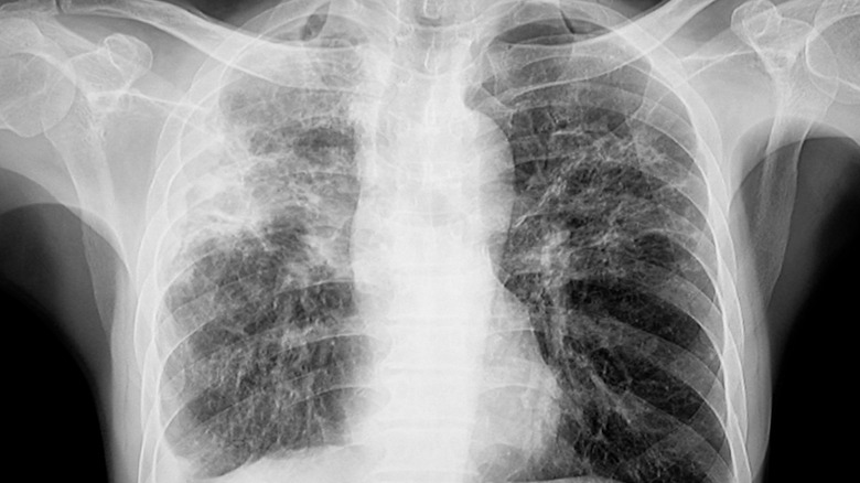 X-ray of cloudy lungs