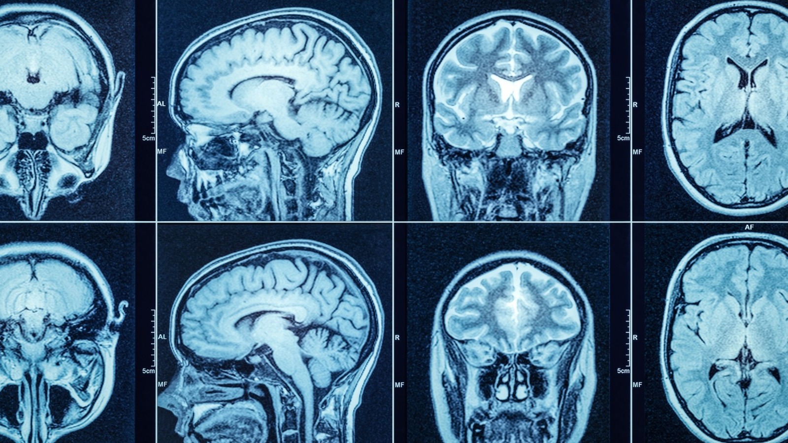 Rare Neurological Diseases You Probably Haven t Heard Of