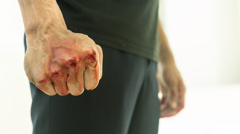 Man with a bloodied fist