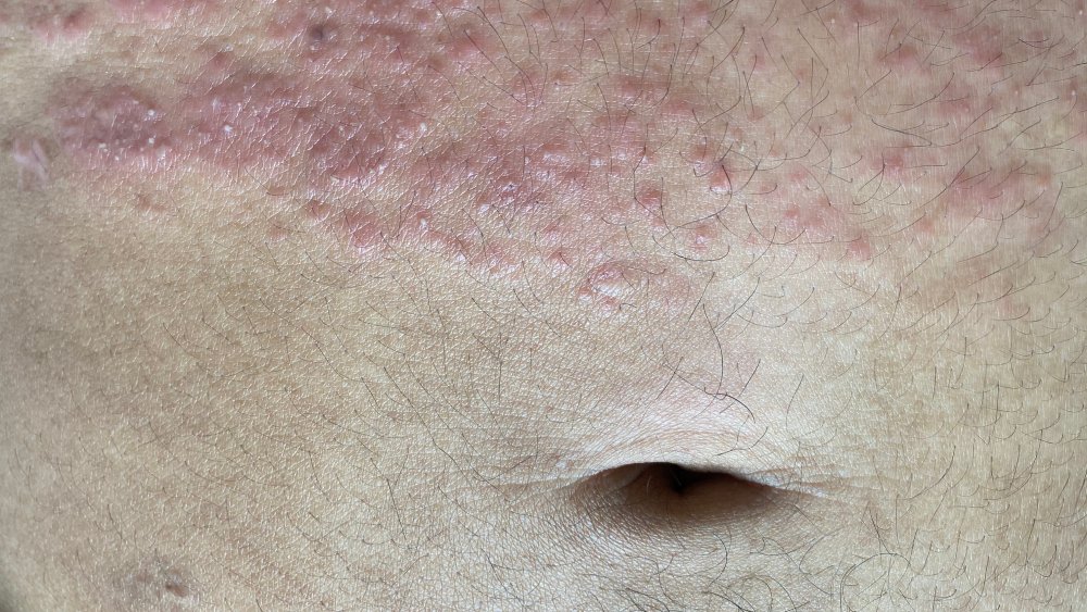 Abdominal rash