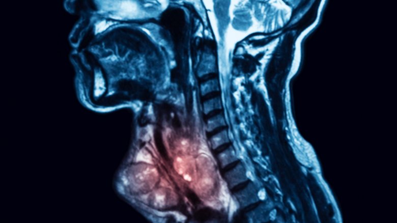 thyroid cancer x-ray