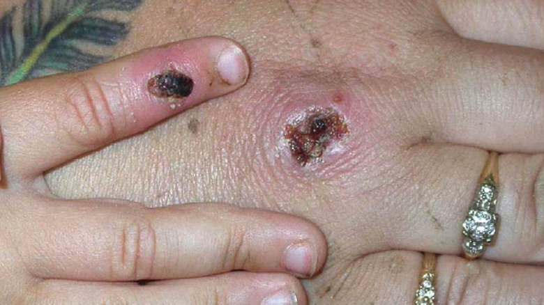 Monkeypox scabs