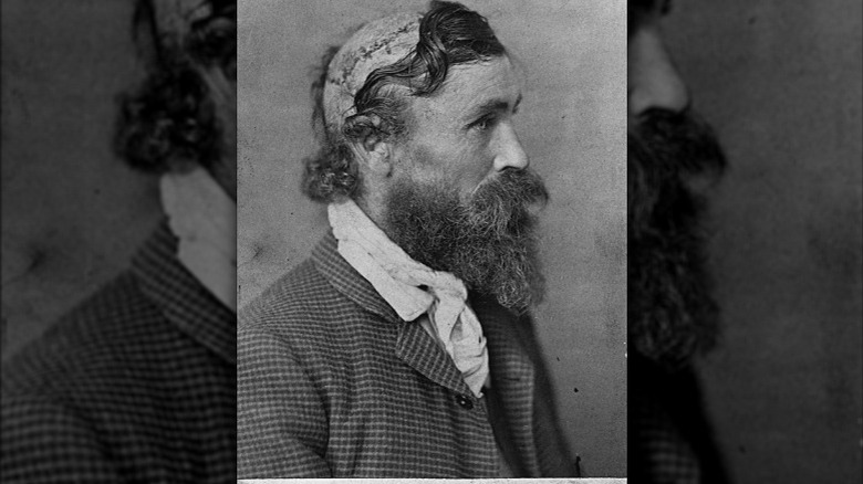 Robert McGee survived a childhood scalping