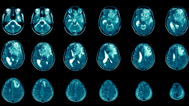 Brain scans from an MRI