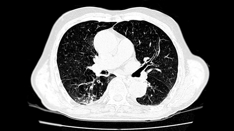 Lung scan for pulmonary embolism