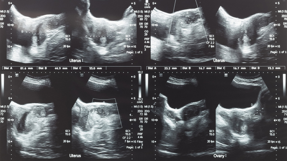 Ultrasound image Ovarian tumor