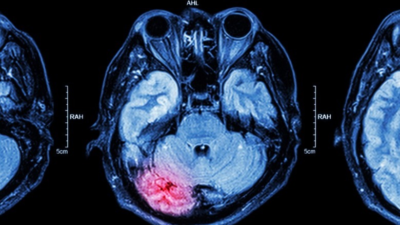 MRI of human brain