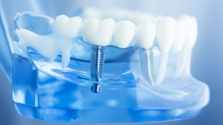 dental implants