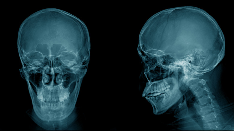 Skull Xray