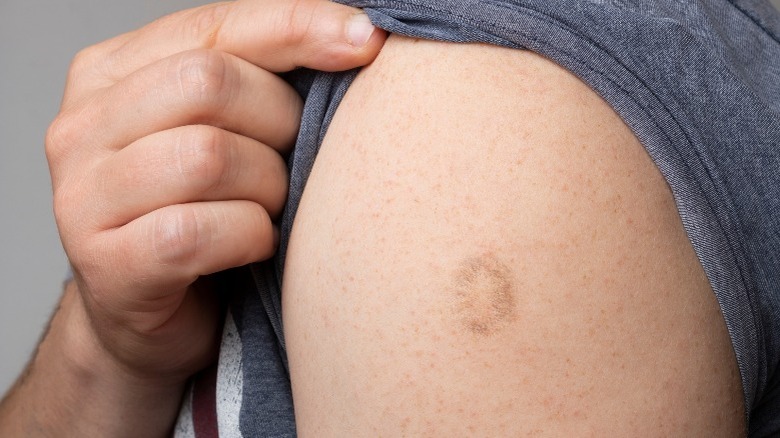 A smallpox vaccine scar on a man's arm