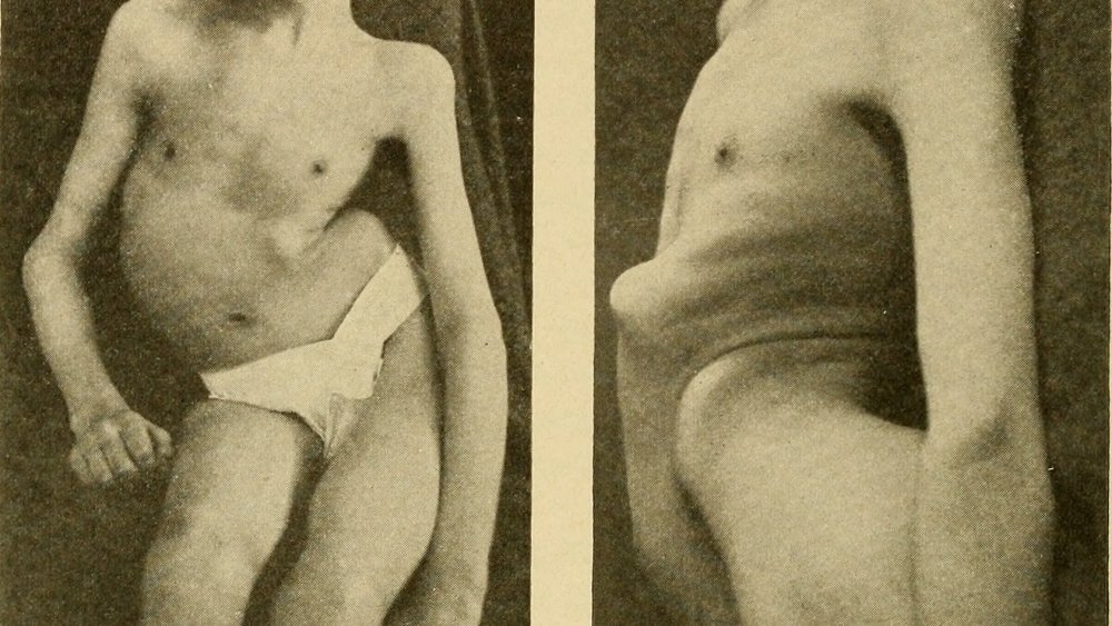 Severe Right Curve due to Infantile Paralysis.