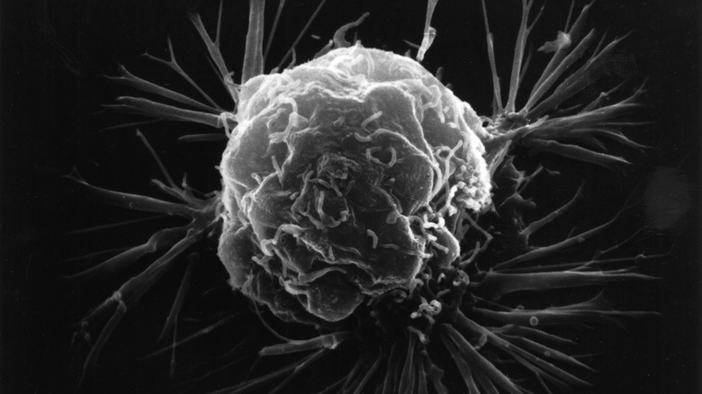 A single female breat cancer cell spreads outward.