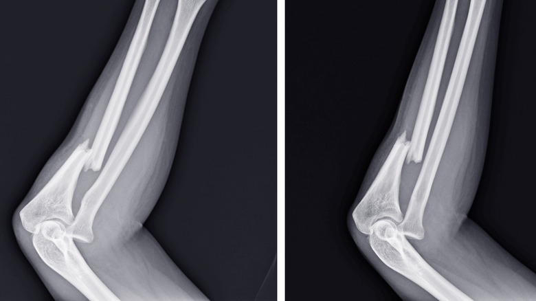 x-ray of broken bones