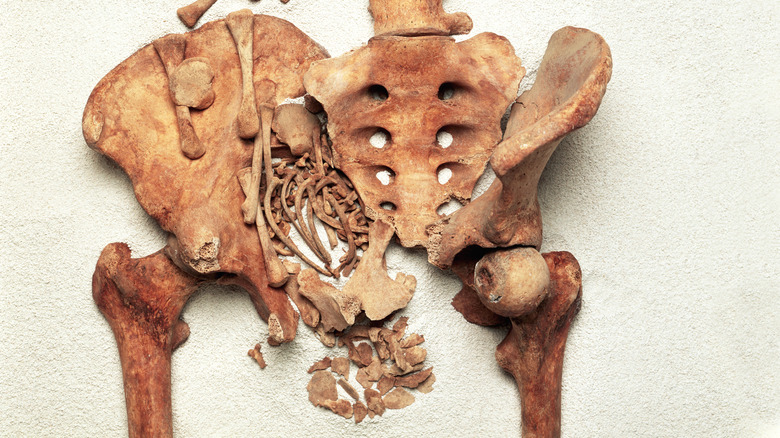 The bones of a child stuck in its mother's birth canal.