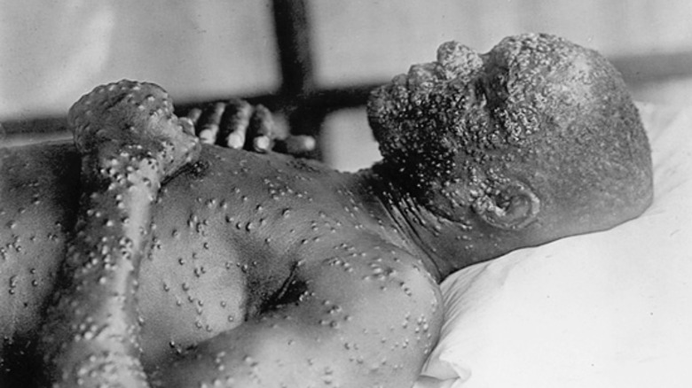 A smallpox victim before the 1959 vaccine.