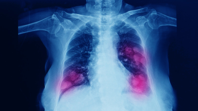 A chest x-ray shows tuberculosis lesions