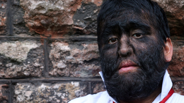 man with Hypertrichosis