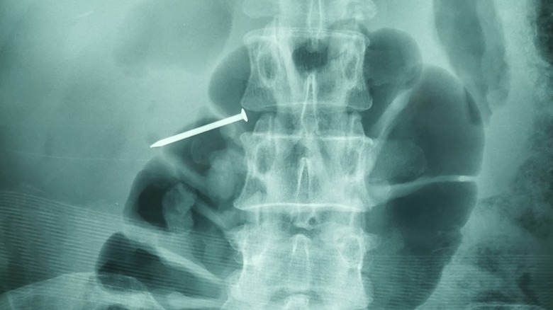 Doctors find nails in patient's abdomen