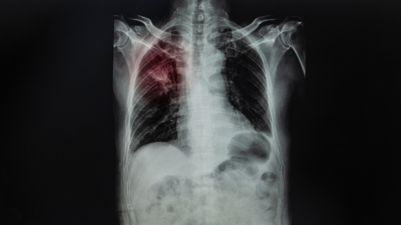 X-ray showing abnormal mass in lung