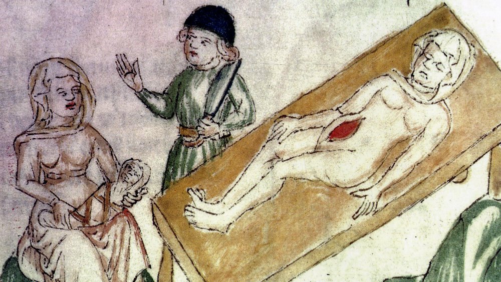 Caesarian Section in medieval Manuscript.