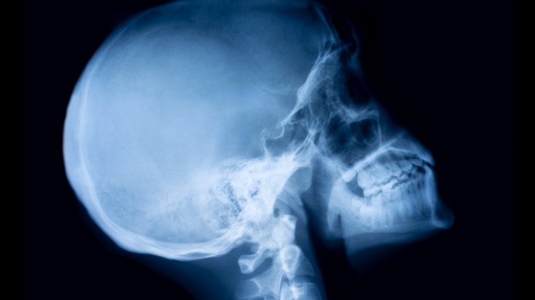 x-ray of skull