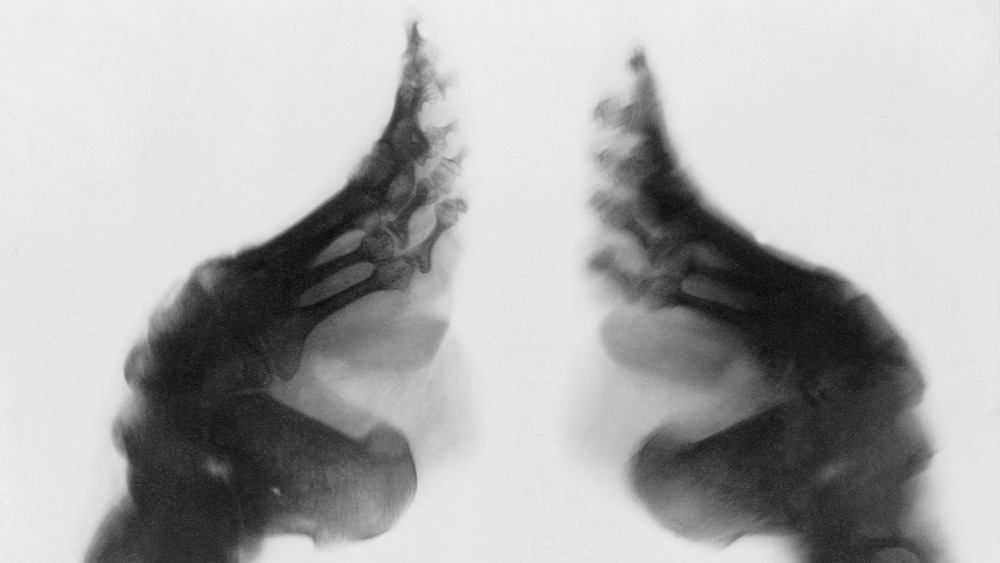 An X-Ray of bound feet