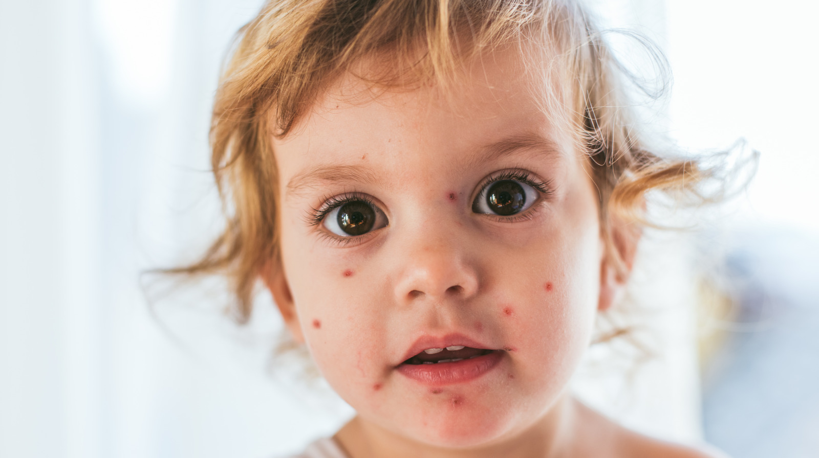 The Truth Behind Chicken Pox Parties