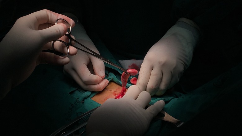 Appendectomy