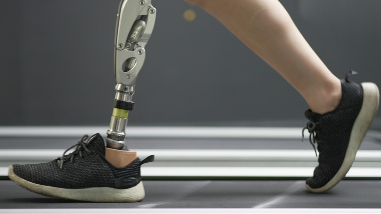 Amputee with artificial limb walking on treadmill