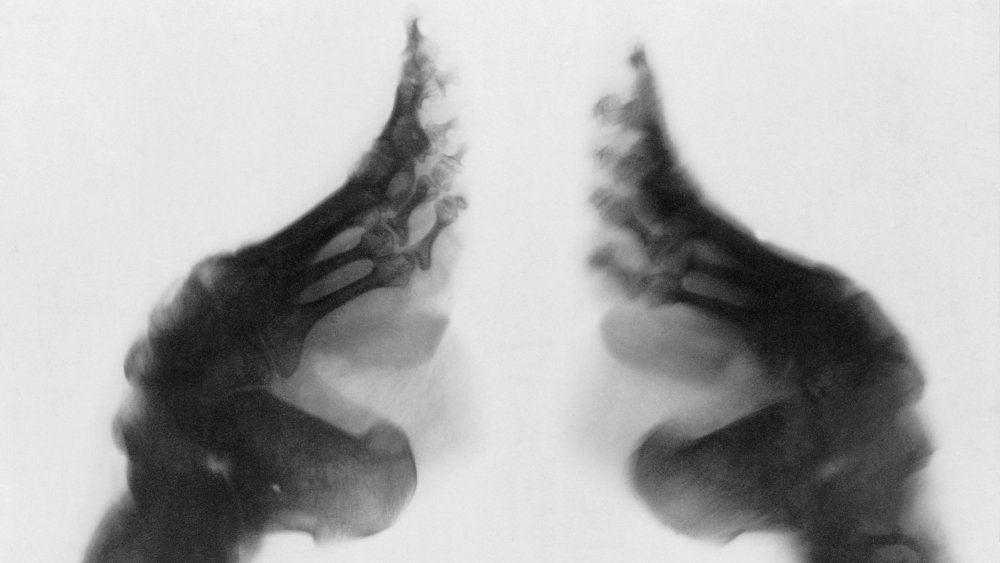 foot binding x-ray