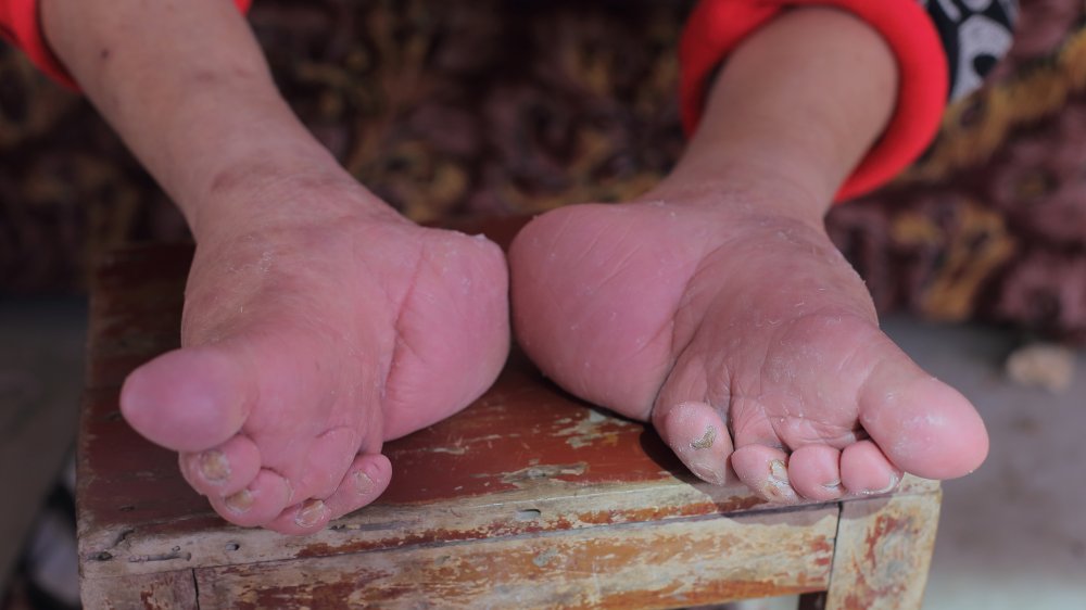 foot binding