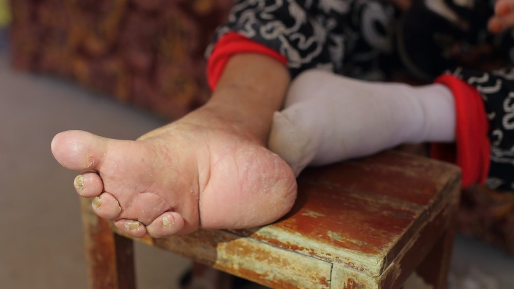 foot binding