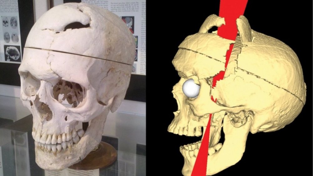 Simulated Connectivity Damage of Phineas Gage