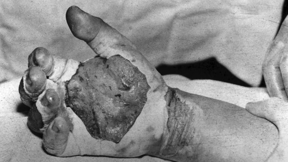 Scientist Harry Dahglian's radiation damage