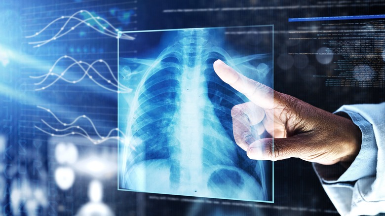 Doctor hand pointing X-Ray lungs