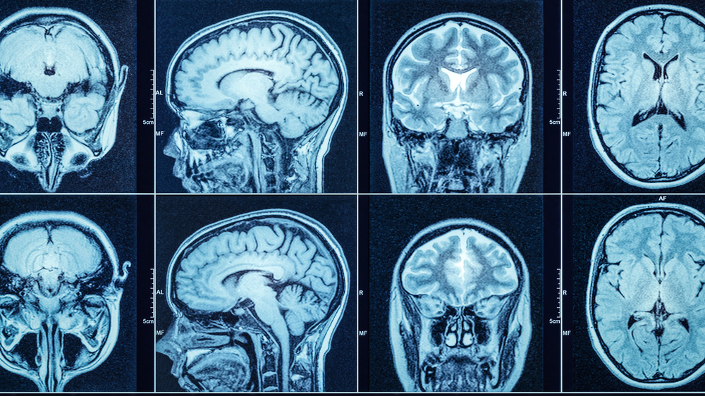 CT brain scan