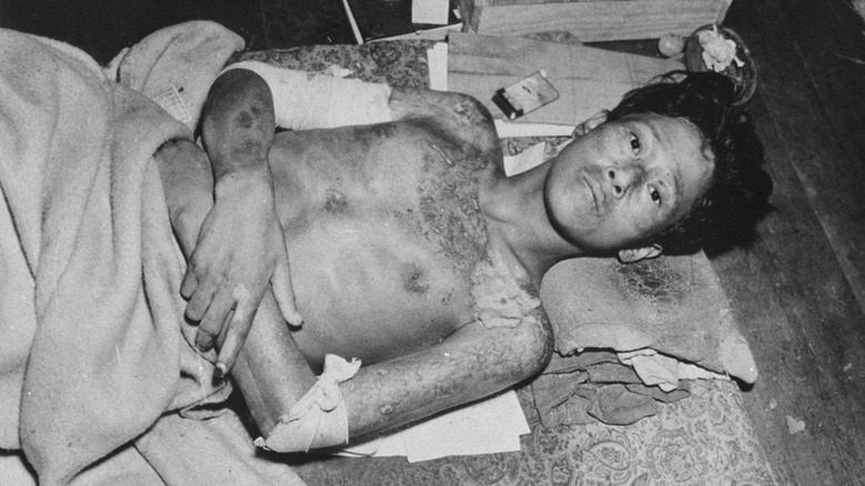 survivor of the atomic bomb in nagasaki