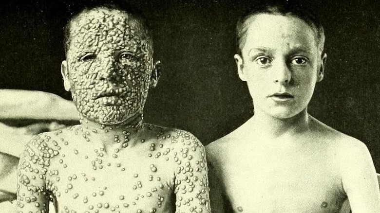 The boy on the left covered with smallpox pustules and a boy on the right with clear skin