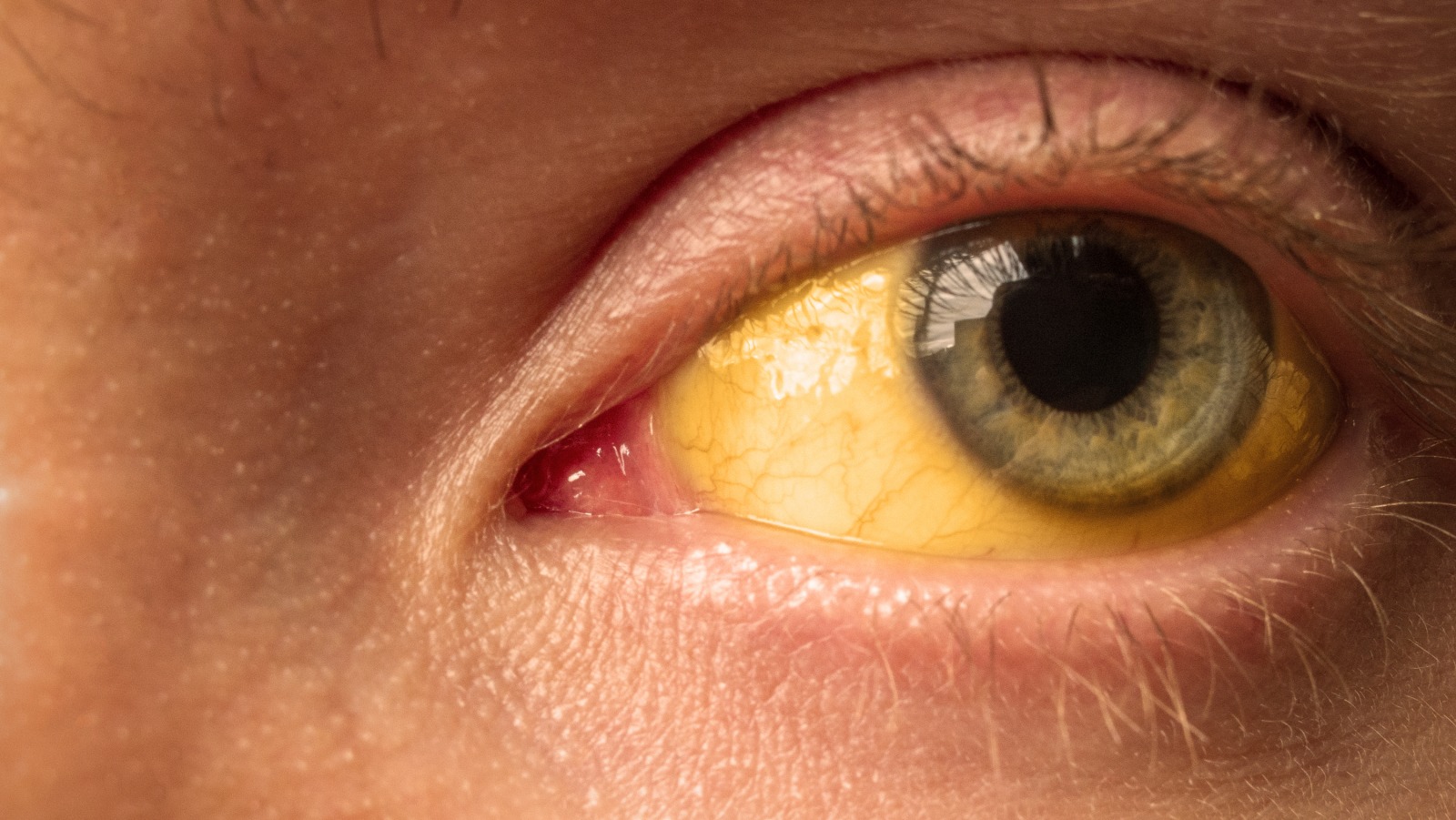 What It Really Means When Your Eyes Turn Yellow